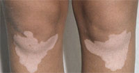 vitiligo